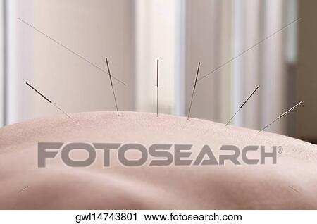 Stock Image - Acupuncture needles on a person's back. Fotosearch