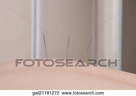 Stock Image - Acupuncture needles on a person's back. Fotosearch