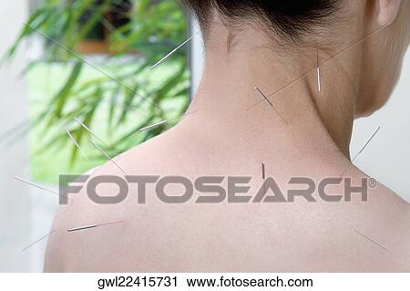 Acupuncture needles on a person's back View Large Photo Image Stock Image - Acupuncture needles on a person's back. Fotosearch