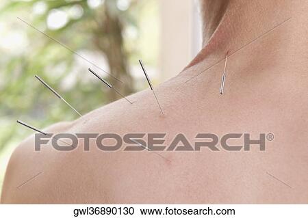 Acupuncture needles on a person's back View Large Photo Image Stock Image - Acupuncture needles on a person's back. Fotosearch