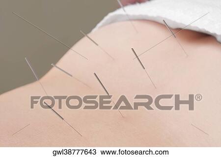 Stock Image - Acupuncture needles on a person's back. Fotosearch
