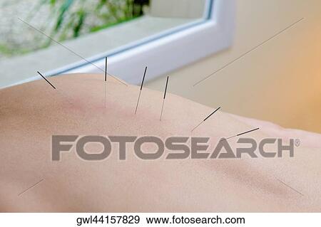 Stock Photo - Acupuncture needles on a person's back. Fotosearch
