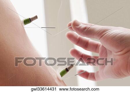 Acupuncturist applying needles and herbal cigars on a person's arm View Large Photo Image Stock Image - Acupuncturist applying needles and herbal cigars on a person's arm. Fotosearch