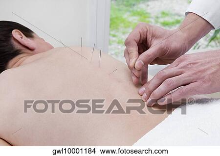 Acupuncturist applying needles on a person's back View Large Photo Image Picture - Acupuncturist applying needles on a person's back. Fotosearch