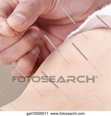 Stock Image - Acupuncturist applying needles on a person's back. Fotosearch
