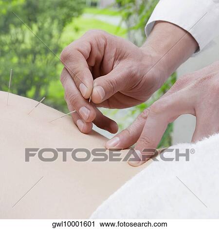 Acupuncturist applying needles on a person's back View Large Photo Image Stock Image - Acupuncturist applying needles on a person's back. Fotosearch