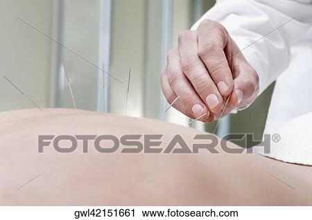 Acupuncturist applying needles on a person's back View Large Photo Image Stock Image - Acupuncturist applying needles on a person's back. Fotosearch