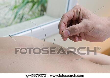 Stock Image - Acupuncturist applying needles on a person's back. Fotosearch