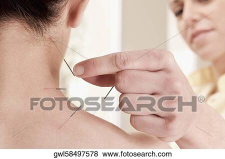 Stock Photo - Acupuncturist applying needles on a person's back. Fotosearch