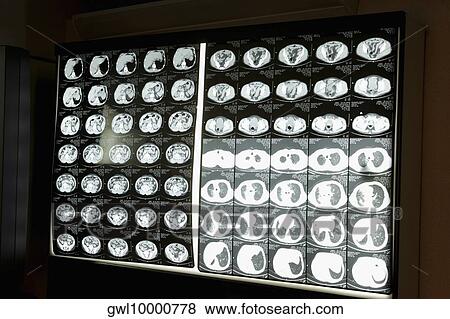 Close-up of MRI scan report View Large Photo Image Stock Photo - Close-up of MRI scan report. Fotosearch