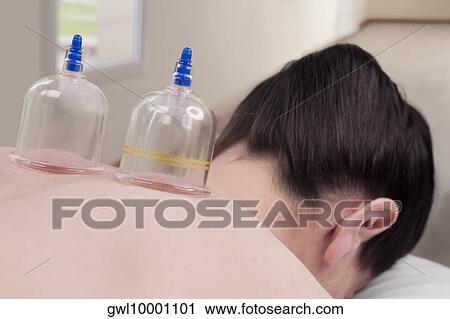 Vacuum cuppings on a woman's back View Large Photo Image Stock Image - Vacuum cuppings on a woman's back. Fotosearch