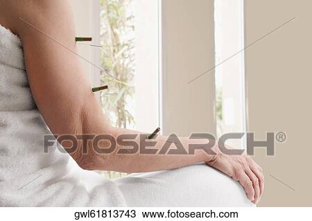 Acupuncture needles and herbal cigars on a person's arm View Large Photo Image Stock Image - Acupuncture needles and herbal cigars on a person's arm. Fotosearch