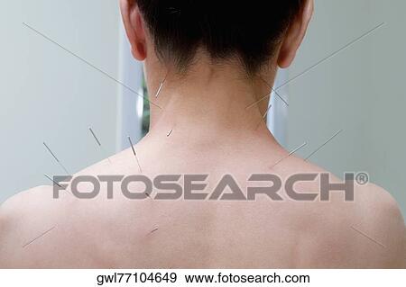 Acupuncture needles on a person's back View Large Photo Image Stock Photo - Acupuncture needles on a person's back. Fotosearch