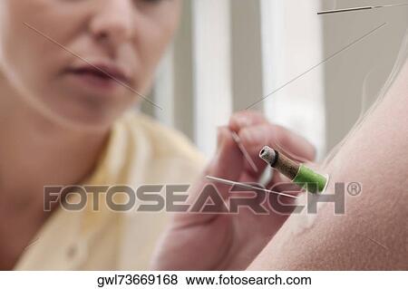 Acupuncturist applying needles and herbal cigars on a person's arm View Large Photo Image Stock Photo - Acupuncturist applying needles and herbal cigars on a person's arm. Fotosearch