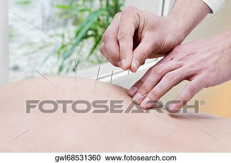Acupuncturist applying needles on a person's back View Large Photo Image Stock Image - Acupuncturist applying needles on a person's back. Fotosearch