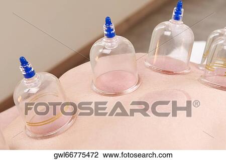 Vacuum cuppings on a woman's back View Large Photo Image Stock Image - Vacuum cuppings on a woman's back. Fotosearch