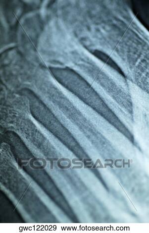 X-Ray image of human bones View Large Photo Image Stock Photo - X-Ray image of human bones. Fotosearch