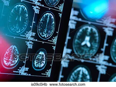 Brain scans of possible disease or damage in clinic View Large Photo Image Stock Image - Brain scans of possible disease or damage in clinic. Fotosearch