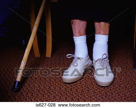 Stock Photo - Unhealthy legs. Fotosearch