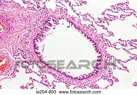 Stock Image - Dilated bronchus. Fotosearch