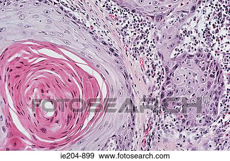 Squamous cell carcinoma View Large Photo Image Stock Photo - Squamous cell carcinoma. Fotosearch