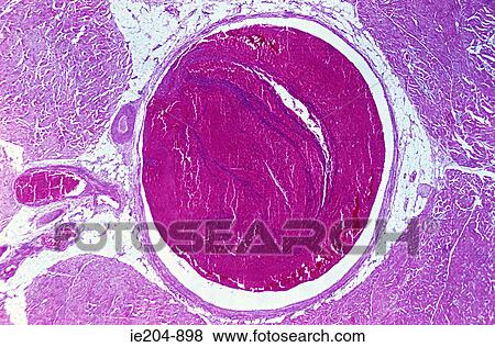 Venous thrombosis View Large Photo Image Stock Photo - Venous thrombosis. Fotosearch