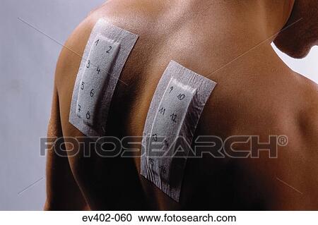 Stock Image - Allergy test. Fotosearch