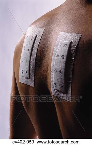 Stock Photo - Allergy test. Fotosearch