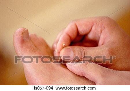 Acupuncture View Large Photo Image Picture - Acupuncture. Fotosearch