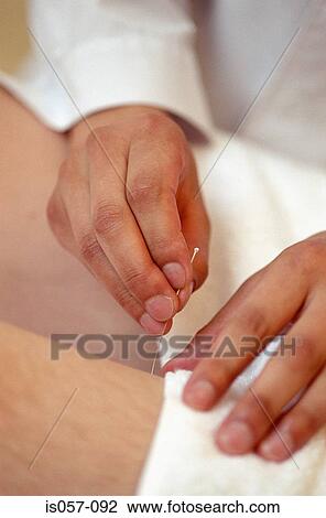 Stock Image - Acupuncture. Fotosearch