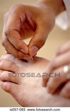Stock Image - Acupuncture. Fotosearch