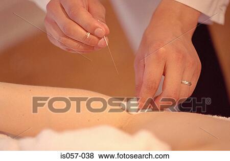 Acupuncture View Large Photo Image Stock Photo - Acupuncture. Fotosearch
