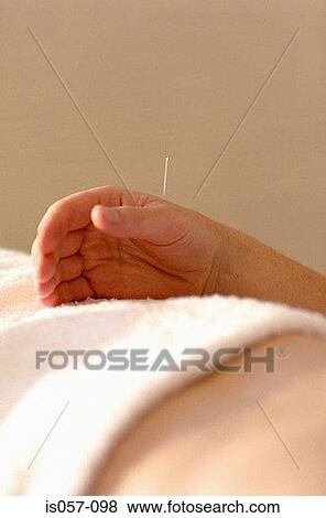 Acupuncture View Large Photo Image Stock Photo - Acupuncture. Fotosearch