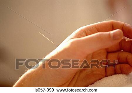 Acupuncture View Large Photo Image Stock Photo - Acupuncture. Fotosearch