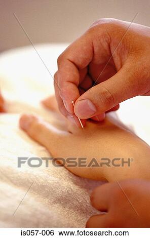 Acupuncture View Large Photo Image Stock Photograph - Acupuncture. Fotosearch