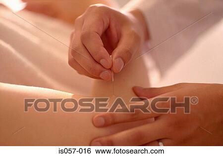 Acupuncture View Large Photo Image Stock Photograph - Acupuncture. Fotosearch