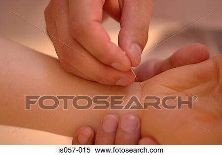 Acupuncture View Large Photo Image Stock Photography - Acupuncture. Fotosearch
