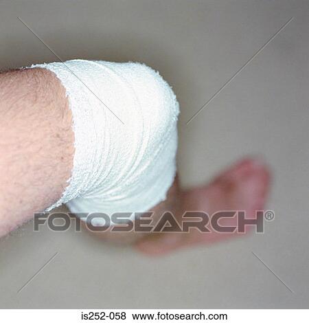 Injured leg View Large Photo Image Stock Photo - Injured leg. Fotosearch