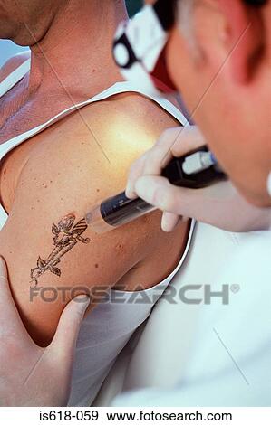 Stock Photo - Man having tattoo removed. Fotosearch