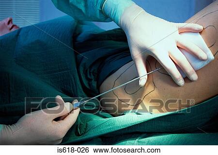 Woman having liposuction View Large Photo Image Stock Photograph - Woman having liposuction. Fotosearch