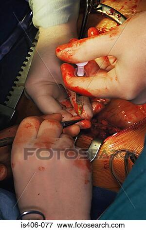 Stock Photo - Injection during an operation. Fotosearch