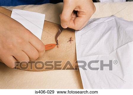 Stock Photo - Removing stitches from leg after surgery. Fotosearch