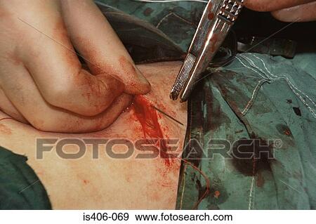 Stock Photo - Sewing up incision in abdomen. Fotosearch