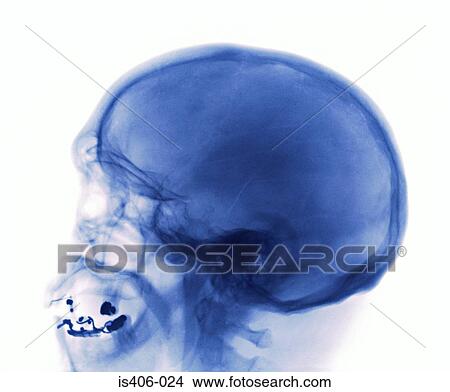 Picture - X-ray of a skull fracture. Fotosearch