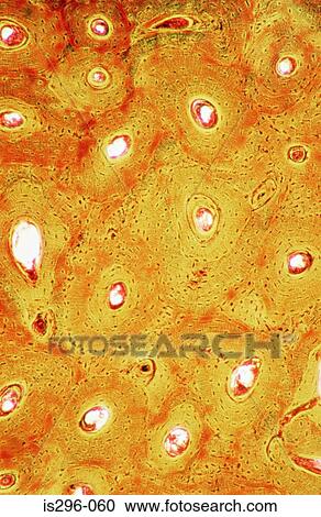 Cavities in bone View Large Photo Image Stock Image - Cavities in bone. Fotosearch