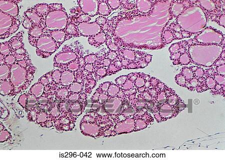 Colloid in thyroid View Large Photo Image Stock Image - Colloid in thyroid. Fotosearch