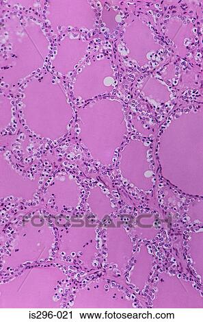Follicles of colloid in thyroid View Large Photo Image Stock Image - Follicles of colloid in thyroid. Fotosearch