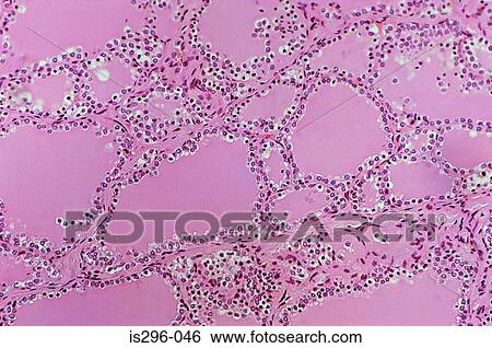 Stock Photograph - Follicles of colloid in thyroid. Fotosearch