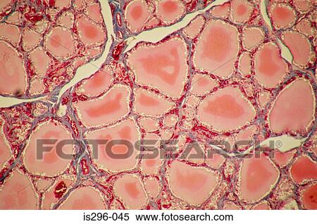 Stock Photography - Follicles of colloid in thyroid. Fotosearch