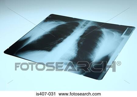 Stock Image - Chest x-ray. Fotosearch